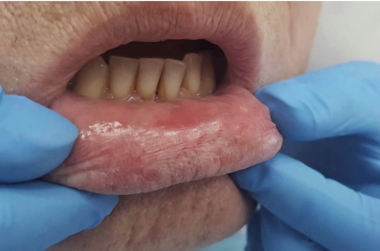 Клинический случай комплексного лечения веррукозной формы лейкоплакии слизистой оболочки рта с применением лазерной абляции и препаратов на основе коллагена