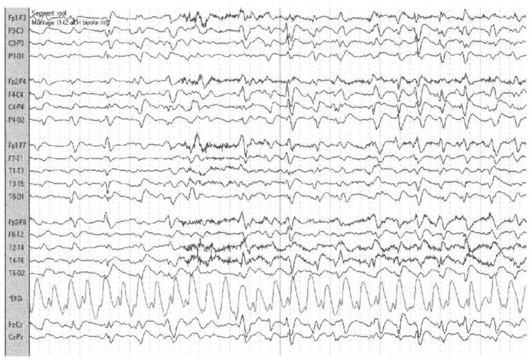 Трифазные волны на электроэнцефалограмме у пациентов с энцефалопатией и их диагностическое значение. Обзор литературы.