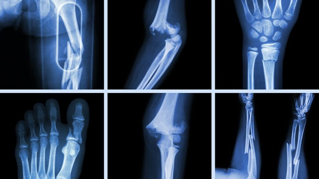 Клиническая диагностика переломов позвонков при остеопорозе (обзор литературы)